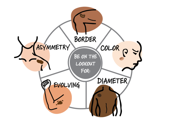 CHM abcde's of melanoma infographic